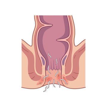 Medical Illustration of Pinworm Infection in the Rectum and Anal Region Showing Parasitic Infestation and Irritation