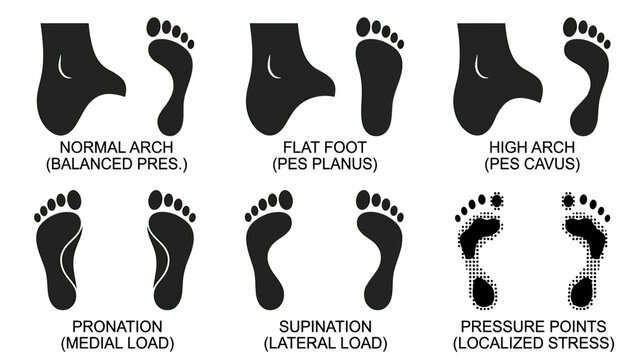 Foot Arch Types and Gait Analysis: Normal, Flat, High Arch, Pronation, Supination