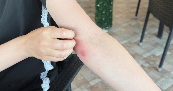Close-up of a woman scratching an itchy mosquito bite on her arm outdoors. Summer concept of insect bites, skin irritation, allergy, and personal health.