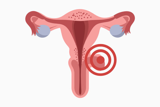 Medical diagram of the female reproductive system highlighting a specific area of pain or disease within the cervix and uterus.