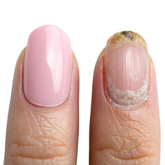 Fototapeta premium Comparison of healthy nail and fungal nail on a white background clearly showing differences