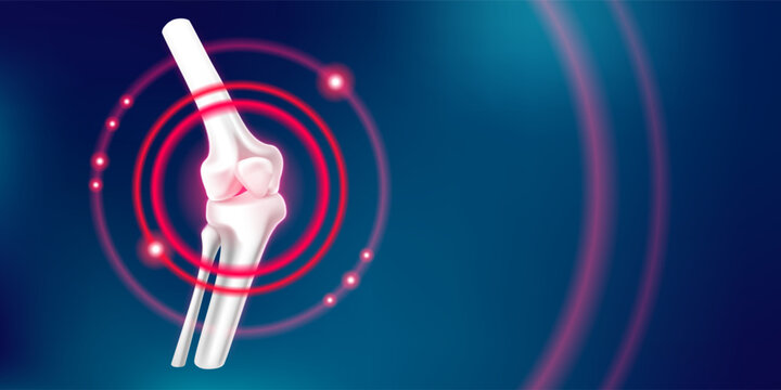 3d rheumatoid anatomical knee joint illustration with realistic bone structure, vector banner with injured pain leg. Medical graphic for orthopedic ads, health protection and arthritis care concepts