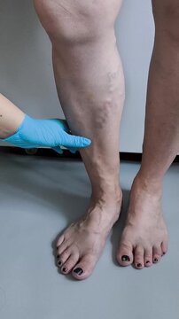 Doctor examining varicose veins on patient's leg, vascular health, phlebology and medical examination concept.