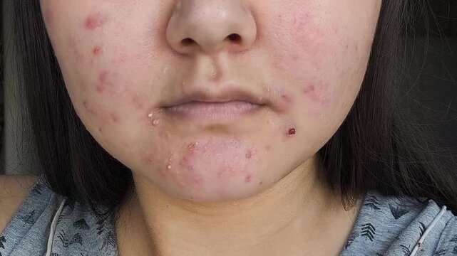 Teen girl with acne-prone skin, pimples, facial redness, skin imperfections and cosmetic dermatology concept.