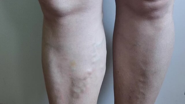 Medical examination of varicose veins on lower leg, vein disease, circulation problems and vascular treatment concept.