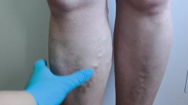 Close up of physician checking varicose veins, venous insufficiency, leg examination and healthcare concept.
