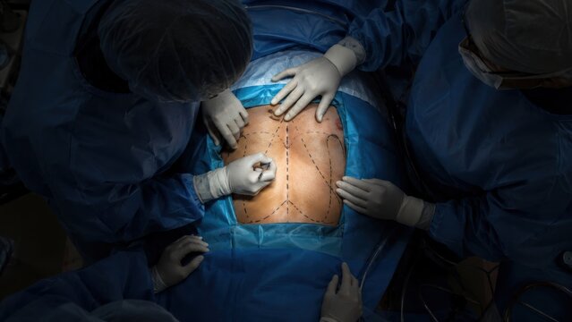 Surgeons marking patient chest for cardiothoracic surgery