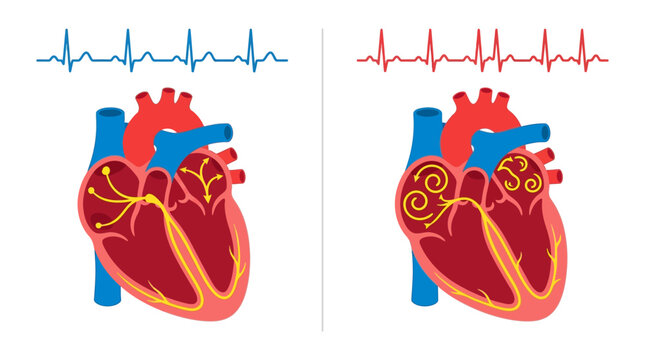 Human Heart Rhythm Comparison featuring normal sinus rhythm and atrial fibrillation with ECG waves. Ideal for medical education and cardiology infographics.