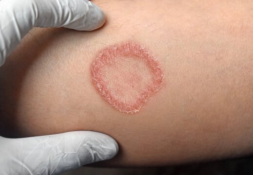 Circular Fungal Skin Infection Ringworm Tinea Corporis Plaque