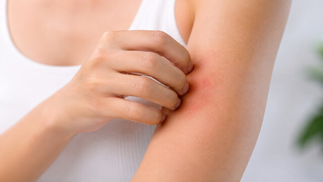 Skin Allergy and Healthcare Problem Concept. Close Up of a Woman Scratching Her Arm with Red Rash Skin. Dermatitis, Psoriasis, Eczema, Symptom, Inflammation, Irritation, and Medical Treatment