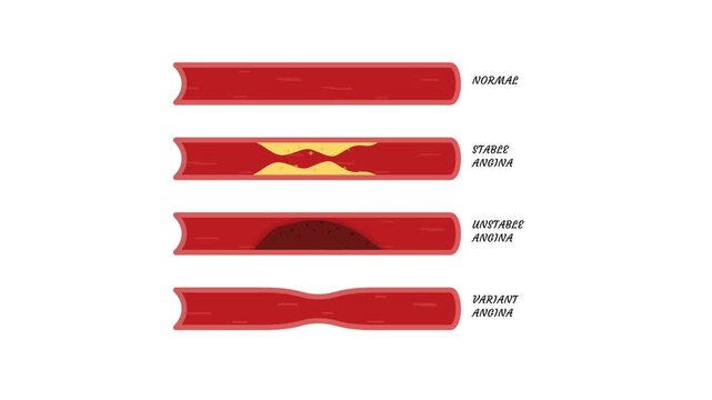 Medical animation comparing normal artery with stable angina plaque, unstable thrombus, and variant spasm in a flat vector infographic for explaining heart disease and cardiovascular health