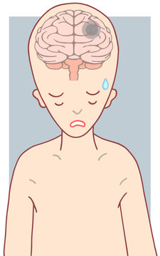 脳の疾患のイラスト - 脳腫瘍・頭蓋内新生物・脳疾患