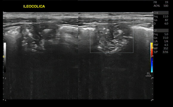 Ultrasound Imaging of Ileocolic Intussusception in the Right Lower Quadrant