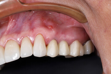 Intraoral view of a tooth abscess with a parulis on the upper jaw gingiva mucosa. Clinical dental examination of inflamed gums infection and periodontal lesion in dental clinic. © WIROT