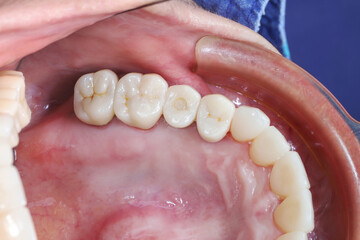 Close up dental photography of upper right teeth arch in human oral cavity. Inside mouth examination of healthy molar anatomy, gums tissue and authentic stomatology treatment. © WIROT