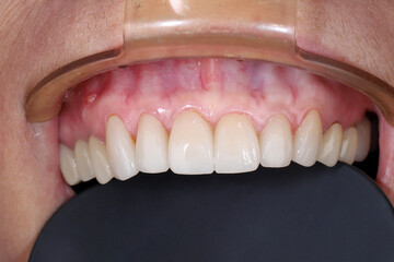 Clinical macro photography of a gum boil parulis from a dental abscess on human upper gingiva mucosa tissue. Intraoral view of periodontal infection and tooth care concept. © WIROT