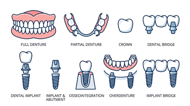 Dental Prosthetics and Implants: Full Denture, Crown, Bridge, Implant