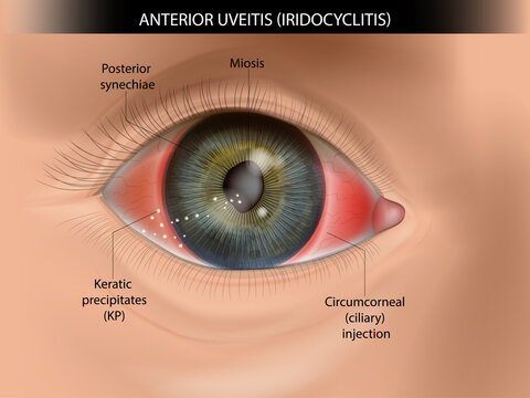 Anterior Uveitis (Iridocyclitis) Clinical Signs Medical Eye Anatomy. Keratic Precipitates and Ciliary Injection Medical Illustration. Ophthalmology Educational