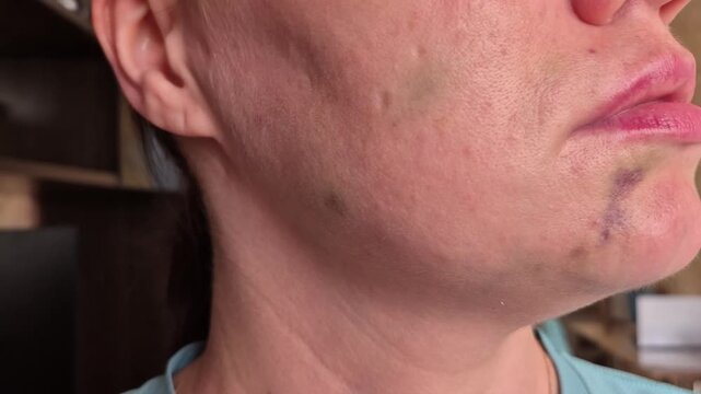 Close-up of the lower face of an adult woman showing injection marks and bruising after a biorevitalization treatment, aesthetic medicine, post-procedure care, skin rejuvenation, recovery process