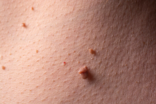 Close Up of Human Skin Papillomas