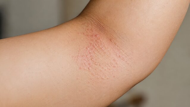 Heat rash skin on inner arm and armpit area close-up showing red bumps and miliaria prickly heat irritation with sweat gland inflammation on raised arm