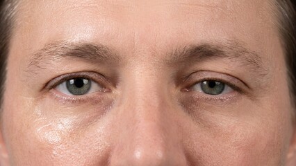 Naklejka premium Close-up of Human Eyes Showing Mild Ptosis and Periorbital Anatomy for Clinical Assessment