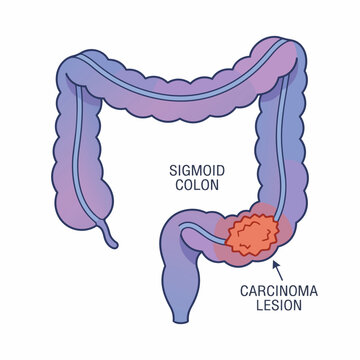 Medical illustration of a carcinoma lesion in the human sigmoid colon, highlighting a cancerous tumor within the large intestine for educational purposes