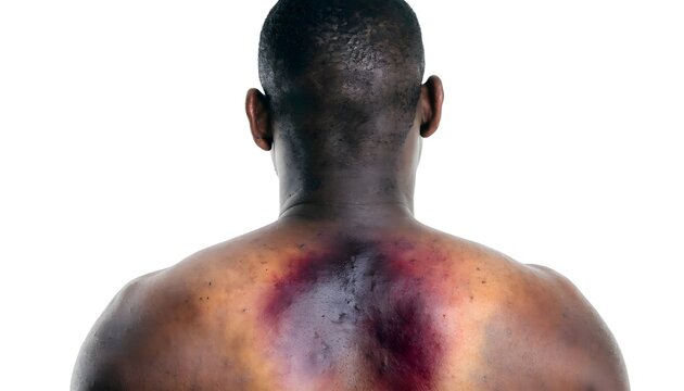 Close-up of large shoulder and upper back hematoma from blunt trauma. Clinical photo of severe male muscle bruising, isolated on white background.