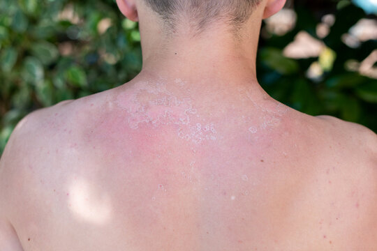 Sunburned back and shoulders of young man with peeling skin after summer sun exposure