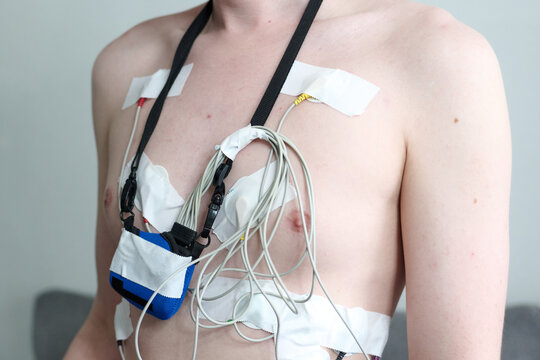 Male torso with holter monitor electrodes and recorder attached.