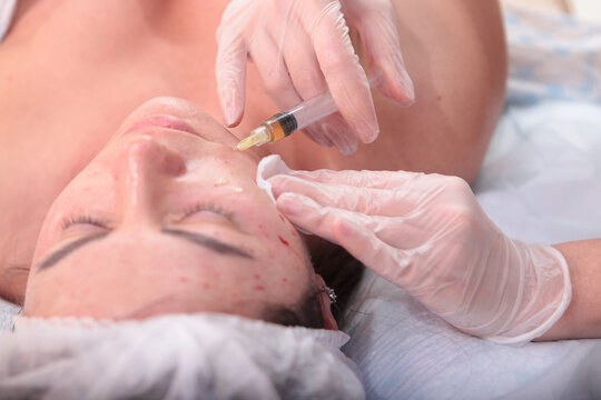 Facial plasmolifting procedure. Injections of plasmolifting in beauty salon. Patient's own biomaterial. Patient's face in close-up. Concept of cosmetology