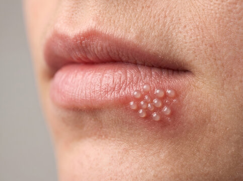 Dermatological view of a mouth affected by herpes simplex virus