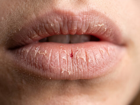 Extreme close up of dry chapped lips with cracked skin