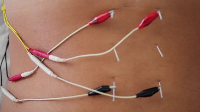 precise catheter insertion into the abdomen in a clinical setting with a top-down perspective and yellow and red medical supplies visible during a healthcare demonstration.