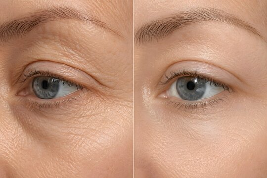 Plasma pen fibroblast eyelid tightening before and after results