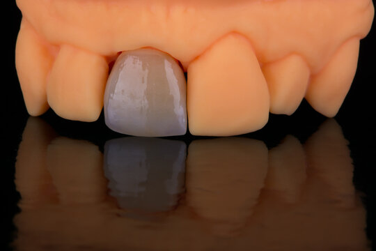 Mirror copy of central maxillary incisor, ultra thin dental ceramic veneer or crown on printed model