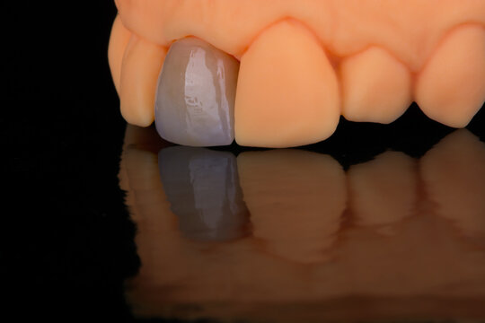 Mirror copy of central maxillary incisor, ultra thin dental ceramic veneer or crown on printed model