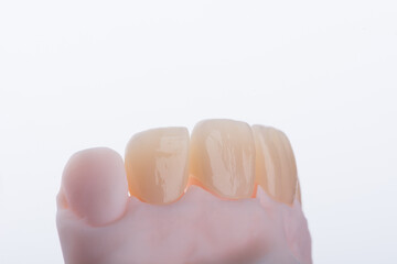 High-quality four dental crowns made of zirconium for fixation to the frontal teeth of upper jaw. © gorynvd