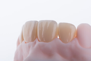 High-quality four dental crowns made of zirconium for fixation to the frontal teeth of upper jaw. © gorynvd