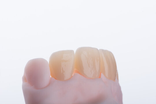 High-quality four dental crowns made of zirconium for fixation to the frontal teeth of upper jaw.