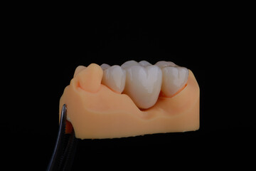 Naturally dental bridge made of zirconium for fixation to upper jaw © gorynvd