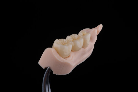 Naturally dental bridge made of zirconium for fixation to lower jaw