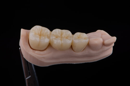 Naturally dental bridge made of zirconium for fixation to lower jaw