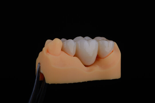 Naturally dental bridge made of zirconium for fixation to upper jaw