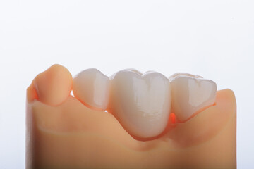 Naturally dental bridge made of zirconium for fixation to upper jaw © gorynvd