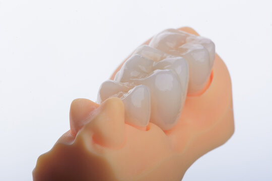 Naturally dental bridge made of zirconium for fixation to upper jaw