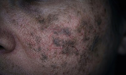 Naklejka premium Extreme macro of mature human skin with severe melasma pigmentation and visible red capillaries