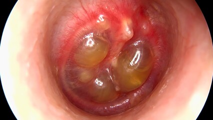 Fototapeta premium Otoscopic view of acute bullous myringitis showing tympanic membrane bullae
