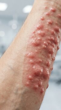 Close-up of Skin Condition with Red Rash and Irritation.
