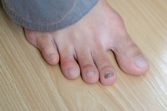 Close-up of a human toe with subungual hematoma and bruised toenail from injury